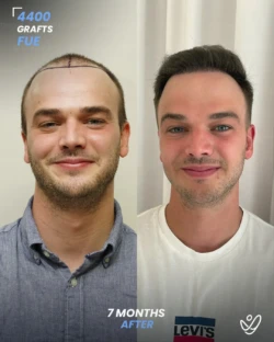 Male FUE 4400 grafts 7 Months Before&After Male FUE 4400 grafts 7 Months Before&After