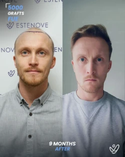 Male FUE 5000 Grafts 9 Months Before&After Male FUE 5000 Grafts 9 Months Before&After