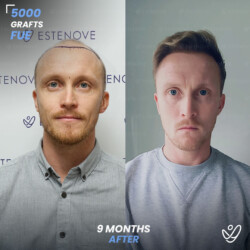 Male FUE 5000 Grafts 9 Months Before&After Male FUE 5000 Grafts 9 Months Before&After