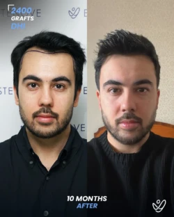 2400 graft DHI 10 months before & after hair transplant 2400 graft DHI 10 months before & after hair transplant