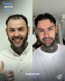 Male FUE 4000 grafts 9 Months Before&After Male FUE 4000 grafts 9 Months Before&After