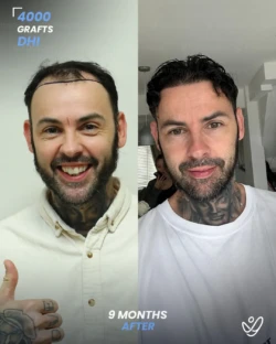 Male FUE 4000 grafts 9 Months Before&After Male FUE 4000 grafts 9 Months Before&After