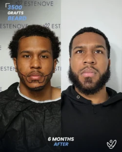 Beard Transplant 3500 Grafts 6 Months Before&After Beard Transplant 3500 Grafts 6 Months Before&After