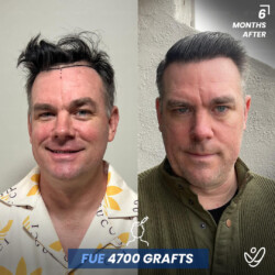 Male FUE 4700 grafts 6 Months Before&After Male FUE 4700 grafts 6 Months Before&After
