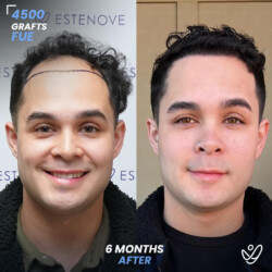 FUE 4500 Graft Hair Transplant 6 Months Before After, Patient Age: 27 - Front FUE 4500 Graft Hair Transplant 6 Months Before After
