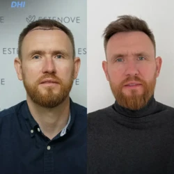 Greffe de Cheveux DHI 3300 greffons 9 mois apres