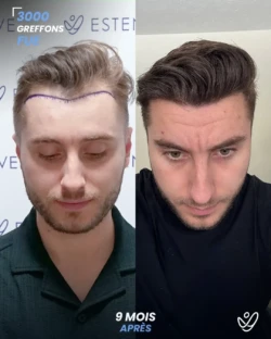 Greffe de Cheveux FUE 3000 greffons 9 mois apres