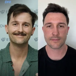 Greffe de Cheveux DHI 2500 greffons 6 mois apres