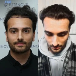 Greffe de Cheveux FUE 5000 greffons 9 mois apres