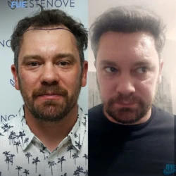 Greffe de Cheveux FUE 4300 greffons 6 mois apres