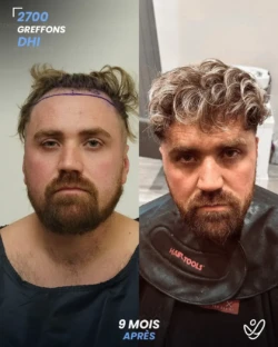 Greffe de Cheveux DHI 2700 greffons 9 mois apres