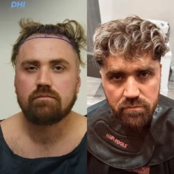 Greffe de Cheveux DHI 2700 greffons 9 mois apres