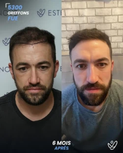 Greffe de Cheveux FUE 5300 greffons 6 mois apres