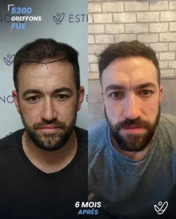 Greffe de Cheveux FUE 5300 greffons 6 mois apres