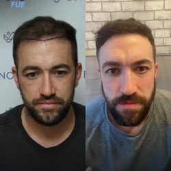 Greffe de Cheveux FUE 5300 greffons 6 mois apres
