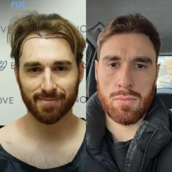 Greffe de Cheveux FUE 3800 greffons 9 mois apres