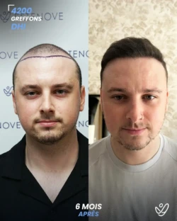 Greffe de Cheveux DHI 4200 greffons 6 mois apres
