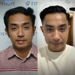 Greffe de Cheveux FUE 4500 greffons 9 mois apres