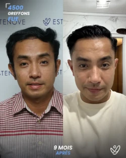 Greffe de Cheveux FUE 4500 greffons 9 mois apres