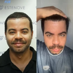 Greffe de Cheveux FUE 2600 greffons 6 mois apres