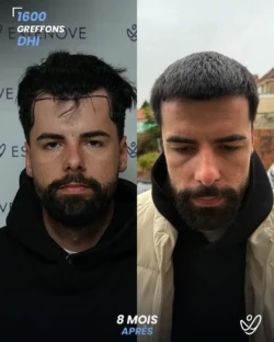 Greffe de Cheveux DHI 1600 greffons 8 mois apres