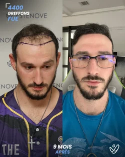 Greffe de Cheveux FUE 4400 greffons 9 mois apres