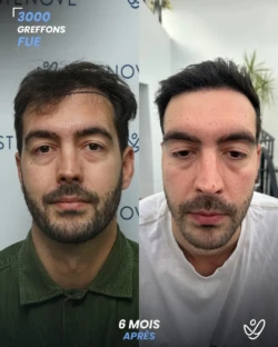 Greffe de Cheveux FUE 3000 greffons 6 mois apres