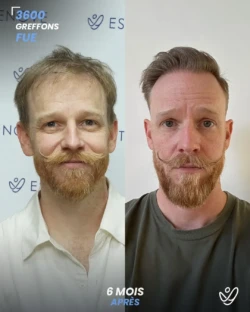 Greffe de Cheveux FUE 3600 greffons 6 mois apres