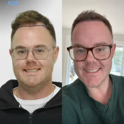 Greffe de Cheveux FUE 5100 greffons 6 mois apres