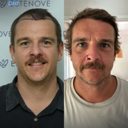 Greffe de Cheveux DHI 3700 greffons 6 mois apres