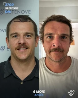 Greffe de Cheveux DHI 3700 greffons 6 mois apres