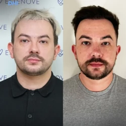 Greffe de Cheveux DHI 2400 greffons 10 mois apres