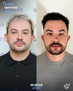 Greffe de Cheveux DHI 2400 greffons 10 mois apres