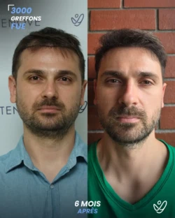 Greffe de Cheveux FUE 3000 greffons 6 mois apres