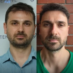 Greffe de Cheveux FUE 3000 greffons 6 mois apres