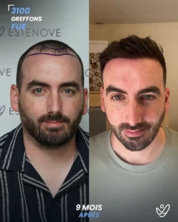 Greffe de Cheveux FUE 3100 greffons 9 mois apres