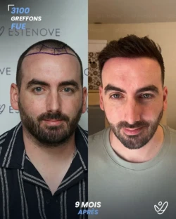 Greffe de Cheveux FUE 3100 greffons 9 mois apres