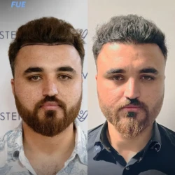 Greffe de Cheveux FUE 2500 greffons 6 mois apres