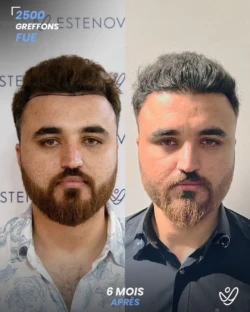 Greffe de Cheveux FUE 2500 greffons 6 mois apres