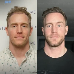 Greffe de Cheveux DHI 4200 greffons 9 mois apres