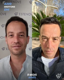 Greffe de Cheveux DHI 4200 greffons 9 mois apres