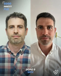 maschile FUE 5000 innesti 9 mesi prima e dopo maschile FUE 5000 innesti 9 mesi prima e dopo