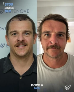 maschile DHI 3700 innesti 6 mesi prima e dopo maschile DHI 3700 innesti 6 mesi prima e dopo