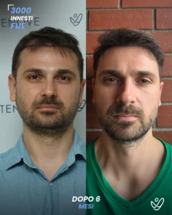 maschile FUE 3000 innesti 6 mesi prima e dopo maschile FUE 3000 innesti 6 mesi prima e dopo