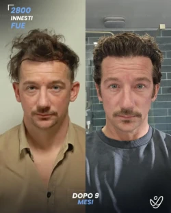 maschile FUE 2800 innesti 9 mesi prima e dopo maschile FUE 2800 innesti 9 mesi prima e dopo