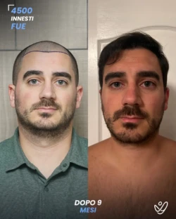 maschile FUE 4500 innesti 9 mesi prima e dopo maschile FUE 4500 innesti 9 mesi prima e dopo