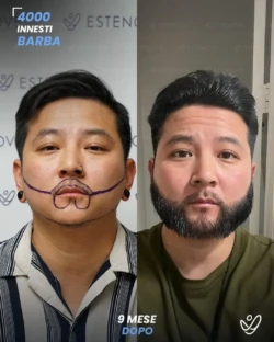 maschile barba 4000 innesti 9 mesi prima e dopo maschile barba 4000 innesti 9 mesi prima e dopo