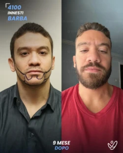 maschile barba 4100 innesti 9 mesi prima e dopo maschile barba 4100 innesti 9 mesi prima e dopo