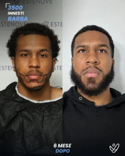 maschile barba 3500 innesti 6 mesi prima e dopo maschile barba 3500 innesti 6 mesi prima e dopo