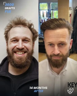 FUE Hair Transplant 3600 Grafts 14 Months Before&After FUE Hair Transplant 3600 Grafts 14 Months Before&After